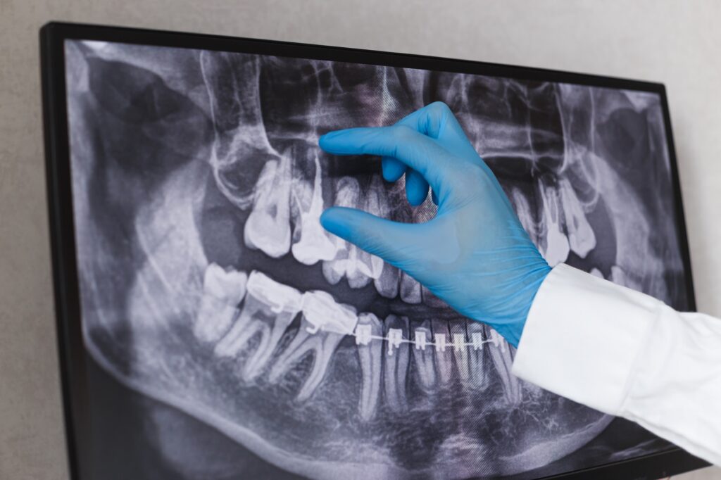 Care este factorul principal care duce la apariția unui implant dentar?