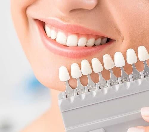 modele de fatete dentare