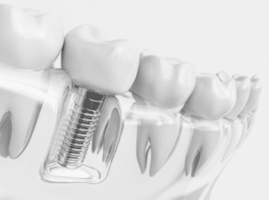 imaginea unui implant dentar