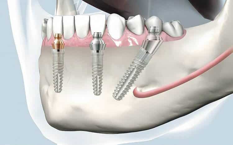 implant dentar sistem all on 4 / all on 6